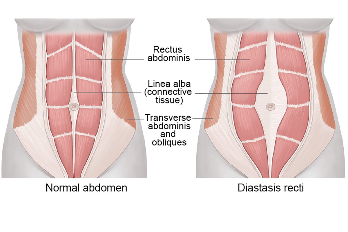 10 things you need to know about Diastasis Recti