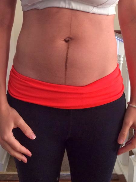 After ReCORE Measurements
Above Belly - ClosedAt Belly Button             
Below Belly Button - ClosedBelly Button Circumference - 28.5