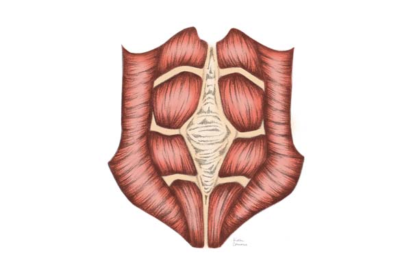 What is Diastasis Recti?